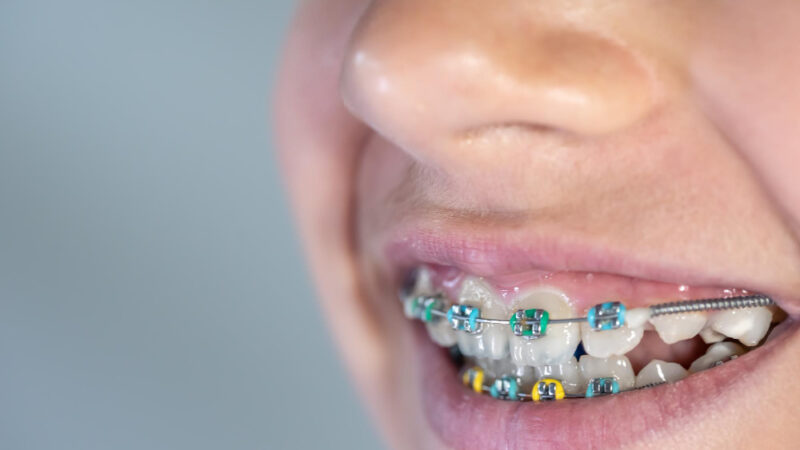 przeciwwskazania do aparatu ortodontycznego
