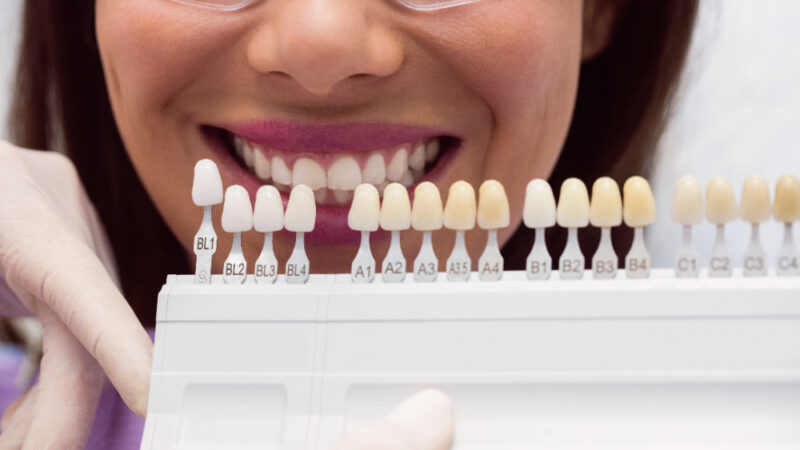 dbanie o licówki kompozytowe