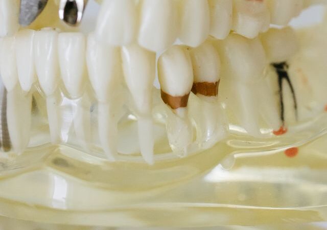 Ile trzeba czekać na implant po usunięciu zęba?