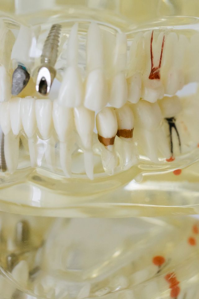 Ile trzeba czekać na implant po usunięciu zęba?