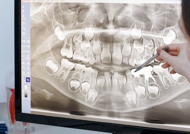 Kiedy po RTG zęba dentysta może zlecić tomografię?